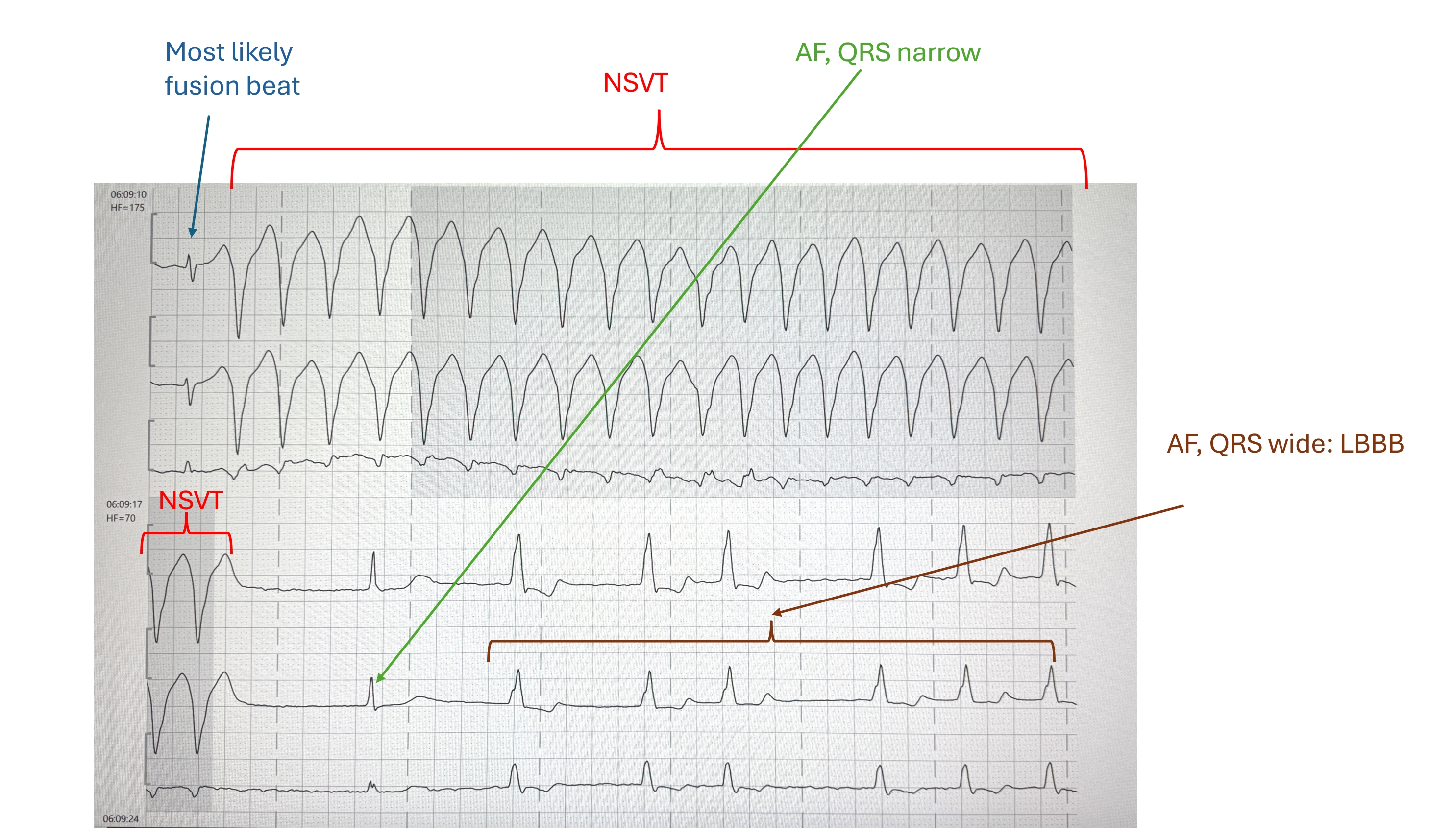 Left bundle branch block | ECG Guru - Instructor Resources
